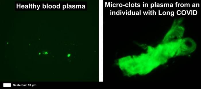 Micro-Blood-Clots-Long-COVID-777x347.jpg