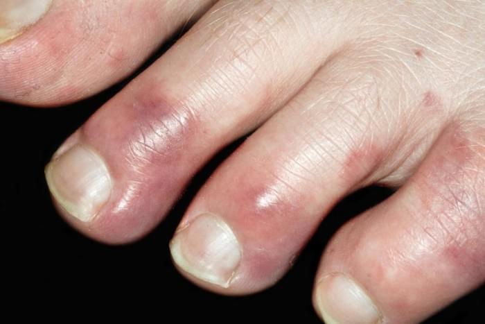 Chilblains-Toes-777x518.jpg