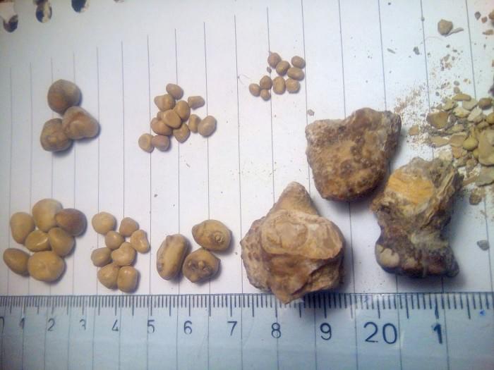 1600px-Kidney_stones_(_renal_calculi_),_Бубрежни_камења_15.jpg