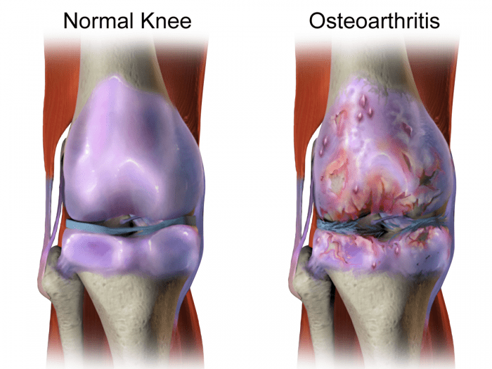 Osteoarthritis.png