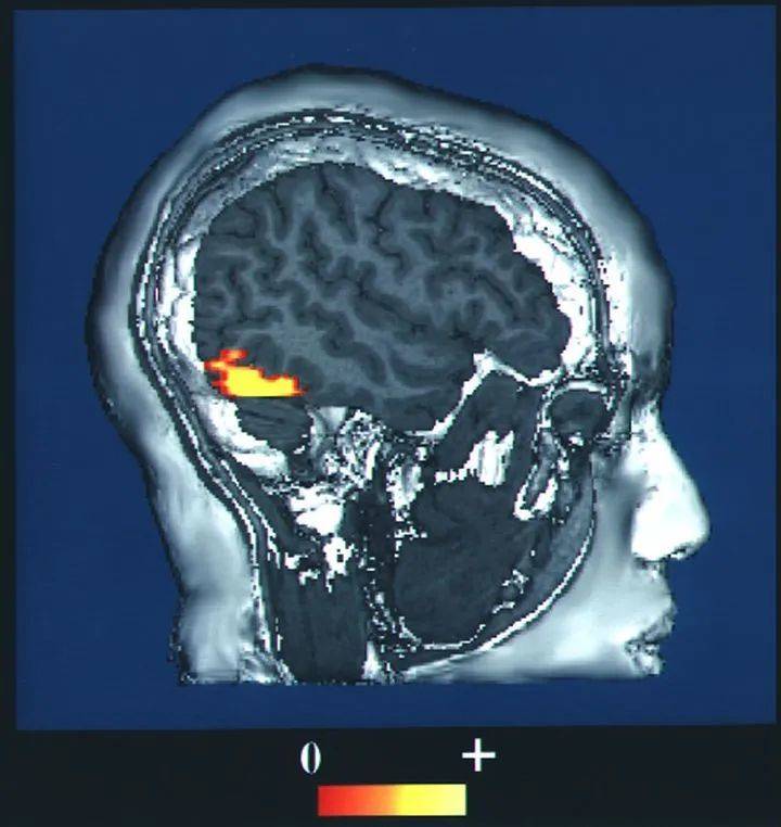 fMRI下检测到的FFA | 图源：Wikipedia