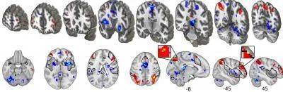 ▲功能核磁共振显示，疼痛过程中，与构建疼痛体验相关的脑区（蓝色）活动减弱，与认知和记忆相关的脑区（红色和黄色）活动加强（图片来源：参考资料[2])<br label=图片备注 class=text-img-note>