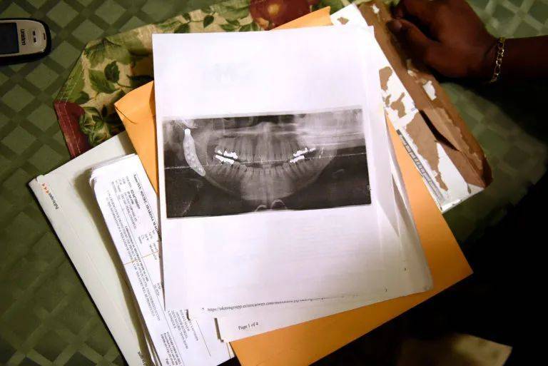 Sharissa Derricott 多次手术后的下颚X光片。图片来源：statnews