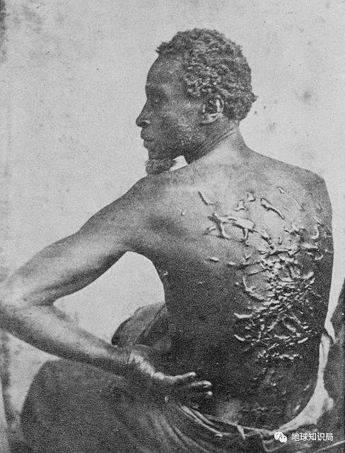 伤疤像恶魔的爪牙一样布满他的背，伤疤的另一头是奴隶主的暴力和暴利（图：Mathew Brady/Wiki）