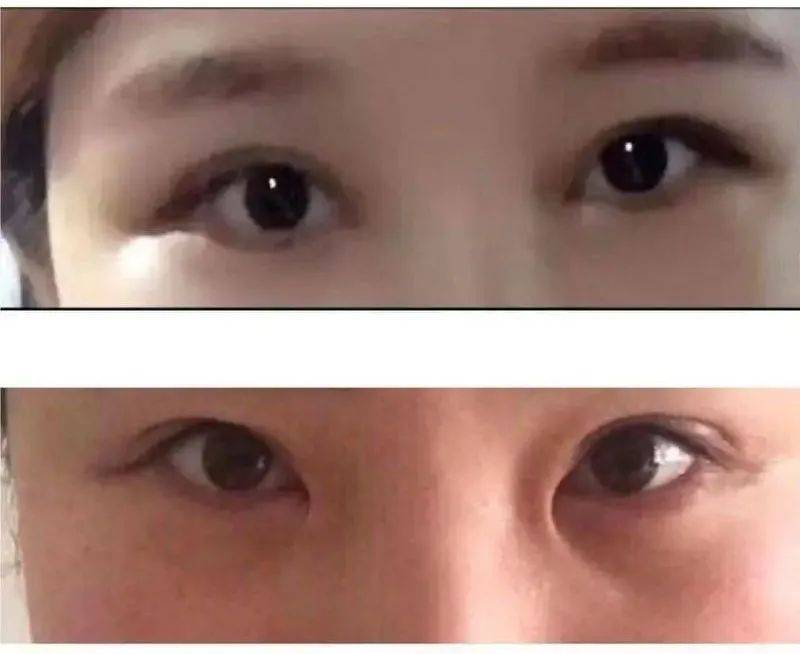 孙雨在来美安术前（图1）术后（图2）眼睛对比。图片由受访者提供