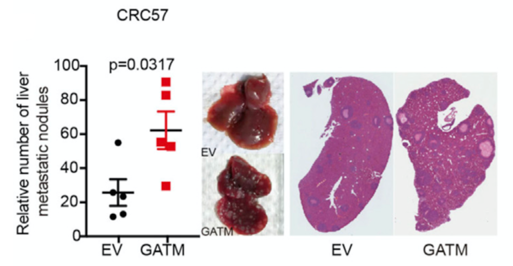 GATM过表达促进肠癌肝转移（EV：空白载体；GATM：GATM过表达）<br>