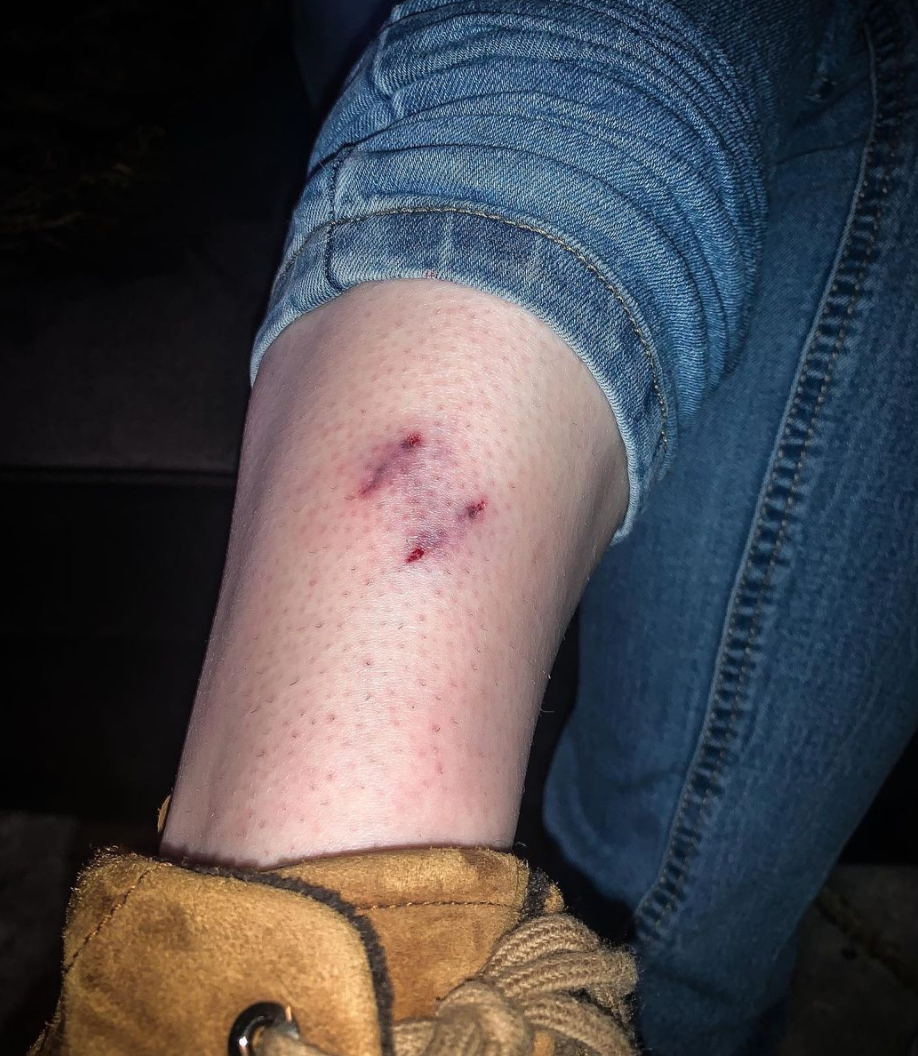 Pip 的主人在社交媒体上分享自己被咬伤的伤痕 | 图源：Instagram @piptheotter<br>