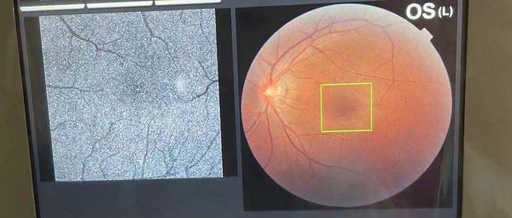 用光学相干断层扫描技术测量眼部。可以检测眼底有无病变。人的眼睛里藏着一颗星球和如此皴裂的地貌！<br label=图片备注 class=text-img-note>