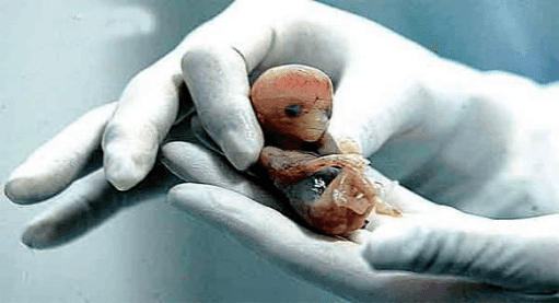 妊娠过程中流产的、发育约两个月的人类胚胎。图片来源：中国生物技术信息网<br>