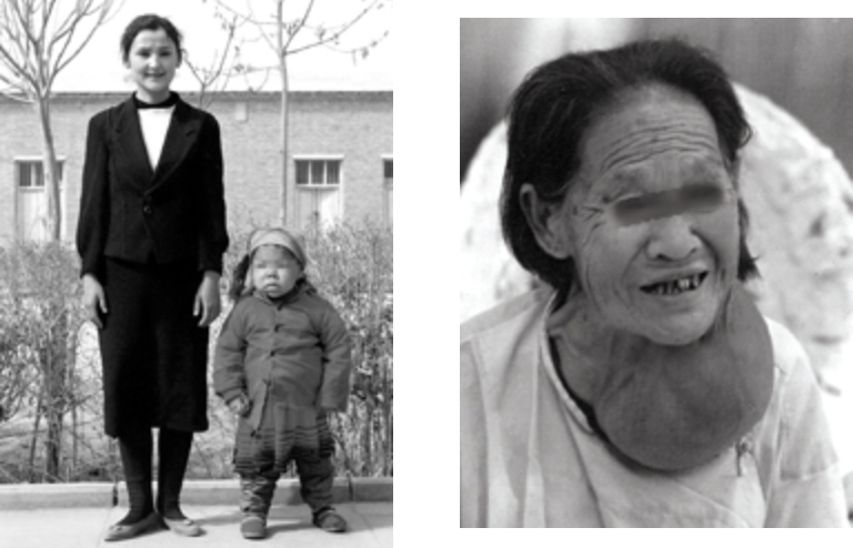 左图是因为缺碘引发的克汀病（呆小症）患者与同龄人比较，右图是缺碘带来的甲状腺肿。图片来源：中国疾病预防控制中心