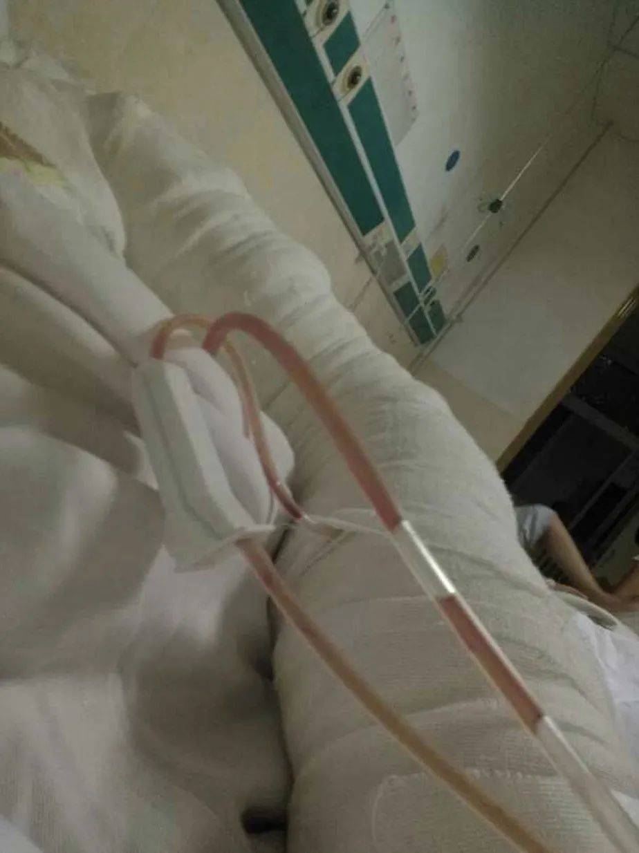 二期手术后在病床上的自拍<br>
