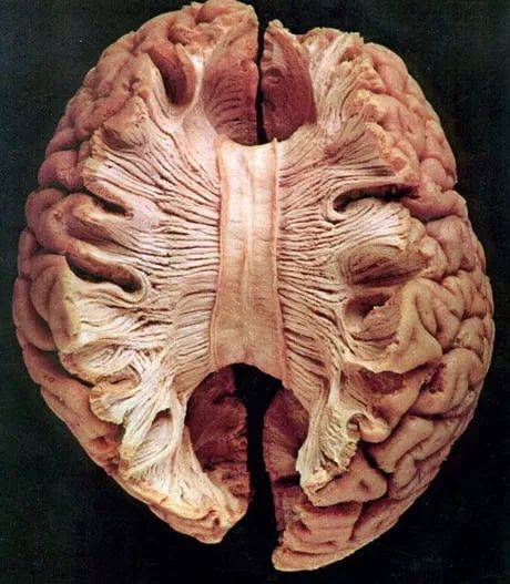 胼胝体（Corpus callosum）是高等哺乳动物大脑中的一个重要白质带，连接左右两个大脑半球，是大脑中最大的白质带，大脑两半球间的通信多数是通过胼胝体进行的。© UCSF Fetal Treatment Center