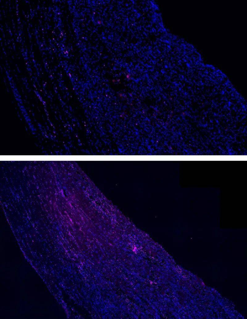 向小鼠肌肉中注入荧光分子的实验结果显示，按摩三天后（上图），组织中分布的嗜中性粒细胞（粉色）数量明显减少（图片来源：参考资料[1]；Credit：哈佛大学Wyss研究所）<br>