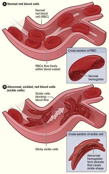 正常红细胞中的红血球（上）和镰刀型红血球（下）的对比 | Public domain<br>