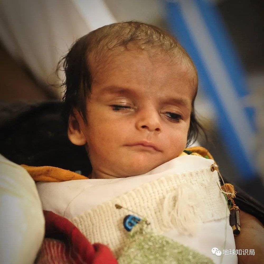 最先被饥饿与病痛缠上的，是儿童，据WFP数据，阿富汗有200万营养不良儿童（不落忍，图：wiki）<br>