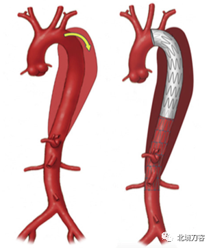 （左：B型主动脉夹层；右：支架介入治疗）<br>