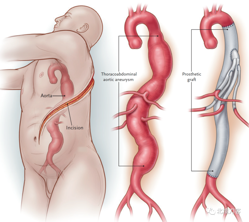 （全胸腹主动脉置换切口与血管重建，来源：NEJM）<br>