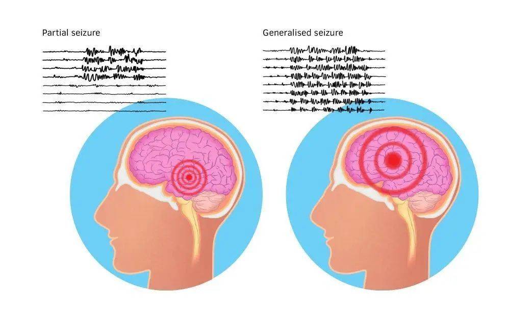 癫痫发作时的脑电图。图片来源：doctorsaustralia<br>
