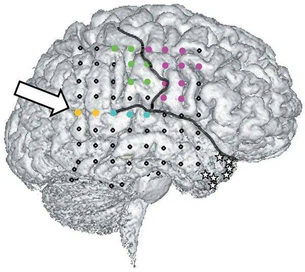 箭头指示的黄色区域，就是研究中电刺激的脑区 | 图源：Blanke O, et al. 2002.<br>
