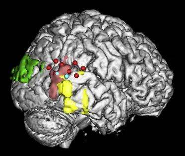 对多名癫痫或偏头痛患者的研究表明，他们会出现灵魂出体的原因，都在这个脑区及其周围区域 | 图源：Blanke O, et al. 2004.