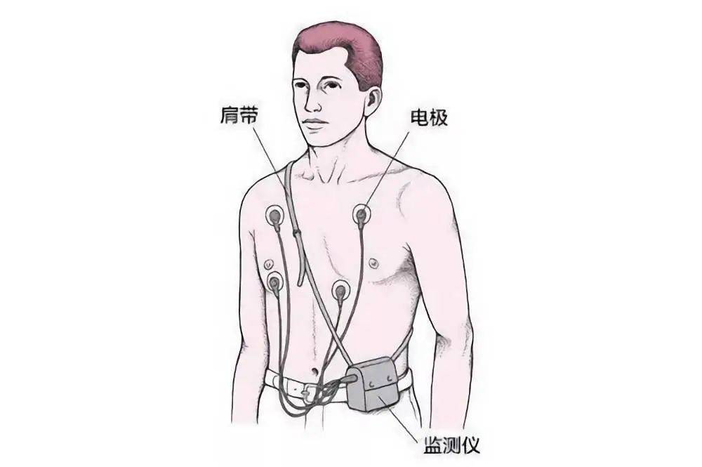 ▲动态心电图又称 Holter 监测，监测仪通过肩带被固定到被检查者的身体上。通过贴在胸壁上的电极，监测仪可持续记录被检查者心脏的电活动.