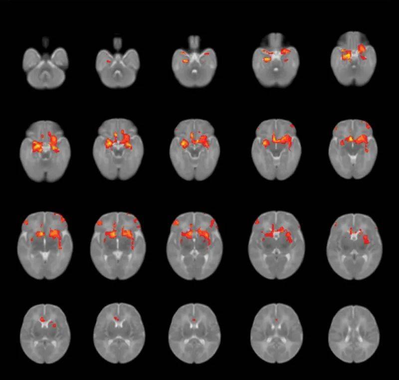 研究人员查看了婴儿大脑中杏仁核（参与情绪处理的脑区）与其他脑区的连接（图片来源：参考资料[1]；Credit：Kathryn Manning）<br>