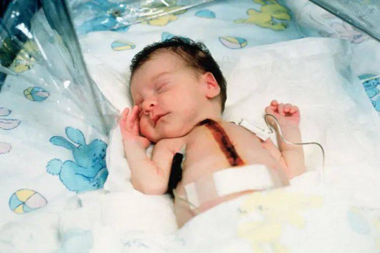 Baby Fae，世界上第一个接受狒狒心脏移植手术的婴儿。图片来自：Wikipedia