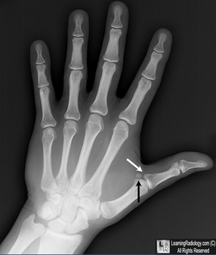 滑雪者拇指可能伴随移位的骨折 | learningradiology