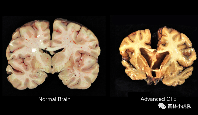正常大脑（左）与CTE大脑（右）的解剖比较（图片来源：wiki)<br>