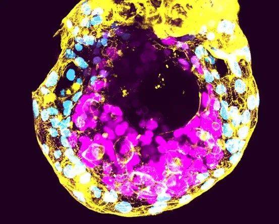 在体外培养了12天的人类胚胎，图中可见将形成胚胎的细胞（品红色部分）。来源：Antonia Weberling， Bailey Weatherbee， Carlos Gantner and Magdalena Zernicka-Goetz
