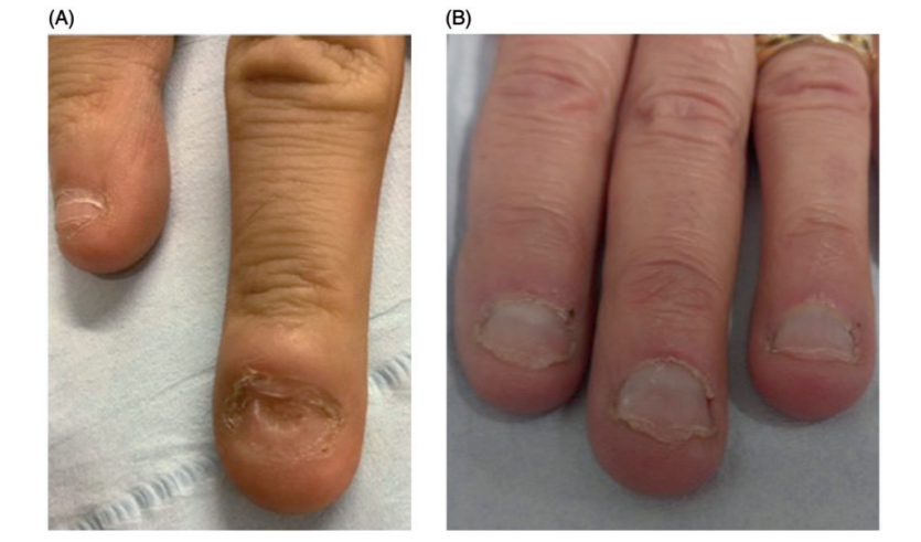 左：45 岁，指甲被咬得凹凸不平；右：67 岁，指甲被咬秃，还伴有慢性甲沟炎，图片来源：Halteh P et al.， Onychophagia: A nail-biting conundrum for physicians
