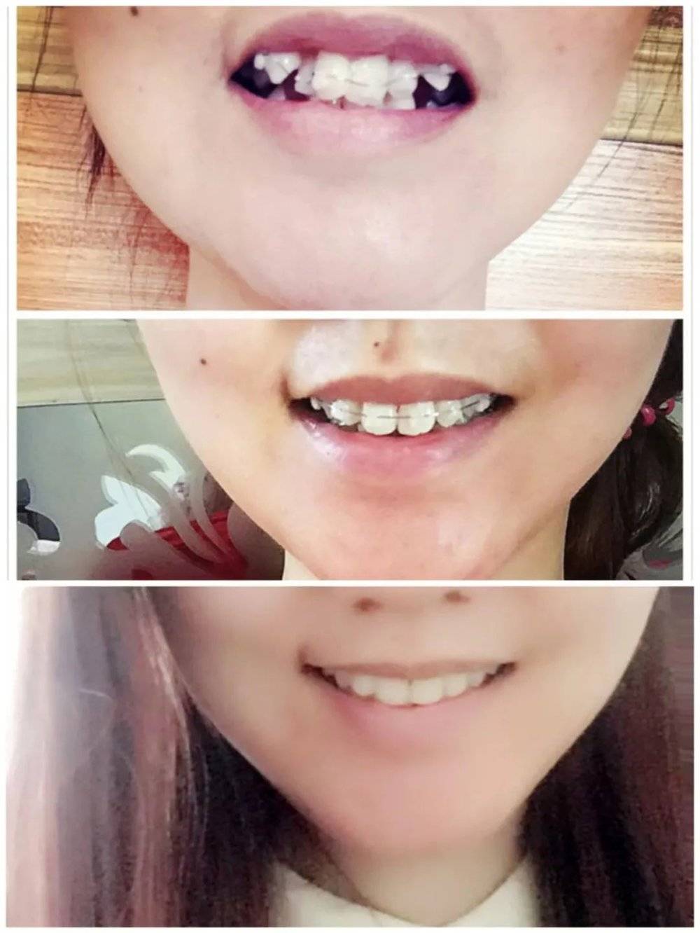 图 |2017年，第一次拆下牙套的王倩，牙齿排列得到改善