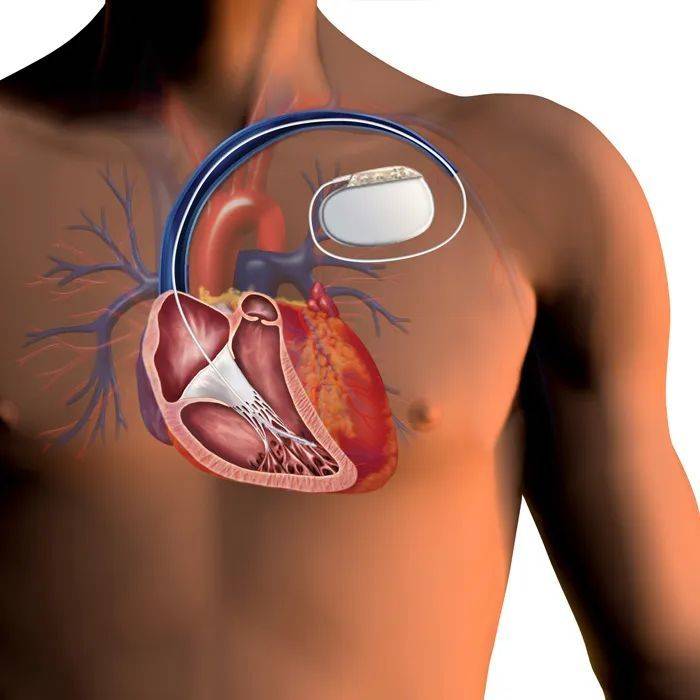 植入型心律转复除颤器（ICD）图示，图源：Washington Heart Rhythm Associates， LLC<br>