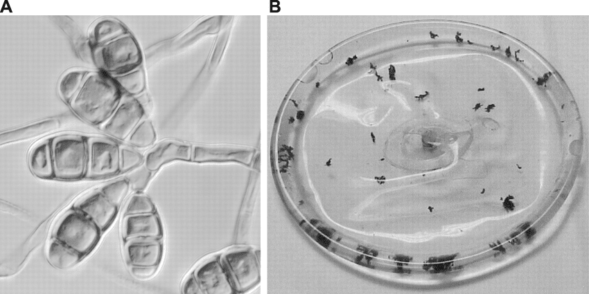 一个被移除的充满盐水的硅胶乳房植入物，带有黑色沉积物，后来被确定为新月弯孢菌（Curvularia lunata）。© ResearchGate<br>