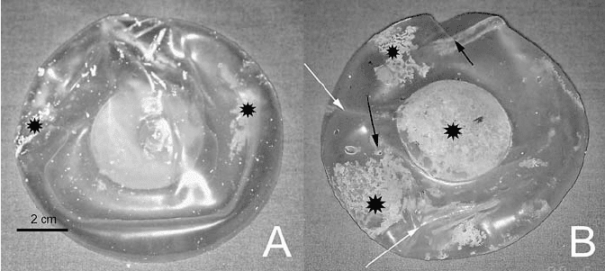 一块移除的已用20年的乳房假体。在其背面（B）可以看到多处孔洞（黑色箭头）以及假体收缩形成的褶皱（白色箭头）。© ResearchGate<br>
