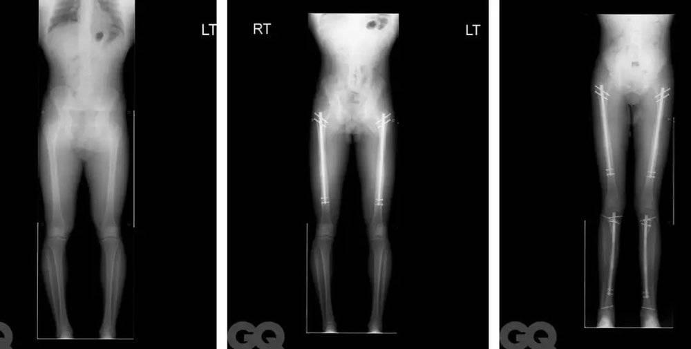 股骨和胫骨都被拉长的前后 X 光片。图片来自：GQ<br>