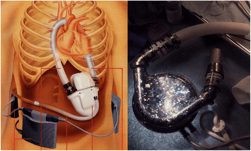 搏动式的心室辅助装置，缺点是体积大。（图片来源：research gate）<br>