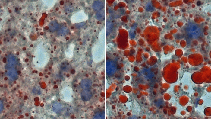 当IPAC<sup>Nts</sup>神经元失活时，小鼠肝脏中的脂滴（红色颗粒）明显更少（左图）（图片来源：Bo Li Lab/CSHL/2022）<br>