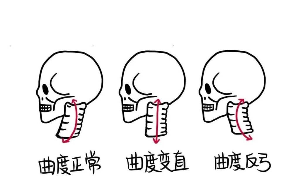 看看你的颈椎到哪个阶段了