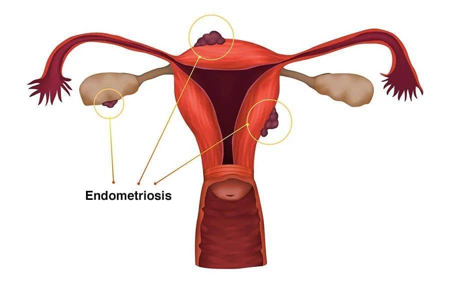 子宫内膜异位症（Endometriosis，EMs）指的是本当存在于子宫内的内膜组织却在子宫外的其他地方生长，多数会在卵巢、输卵管以及子宫附近的组织，少数的情况也可能发生在身体的其他部位。主要的症状有骨盆腔疼痛以及不孕。有七成的疼痛感发生在经期，性交时产生疼痛感也很常见。© Healthdirect