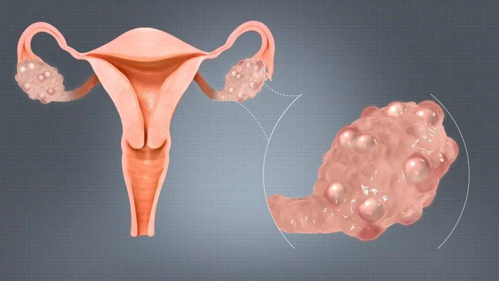 多囊性卵巢综合症（Polycystic ovary syndrome，PCOS），是女性因为雄性激素上升所导致的症状。该症状包含月经不规律或是无月经、月经量过多、多毛症、粉刺、盆腔疼痛、难以受孕与黑棘皮症。© Cleveland Clinic