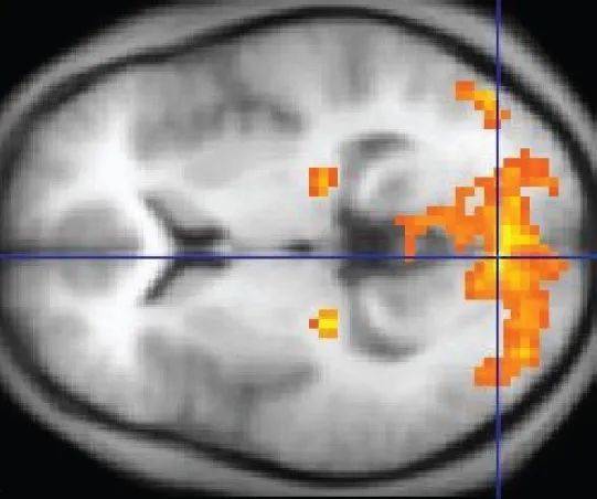 该fMRI图像中，黄色部分为大脑中的活跃区域。图源：Wikimedia Commons