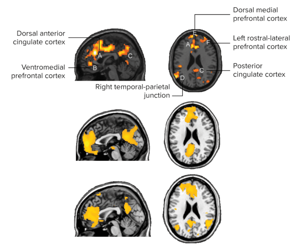 A：背侧前扣带回皮质 B：腹内测前额叶皮质 C：后扣带回皮质 D：右颞顶部结 E: 背内侧前额叶皮质 F：左前额叶前部外侧皮质。在三个不同的实验中，当受试者承认他们走神时，相对应的大脑区域会被激活，以上功能性磁共振成像扫描的结果。这些区域都属于大脑中的默认模式网络系统。