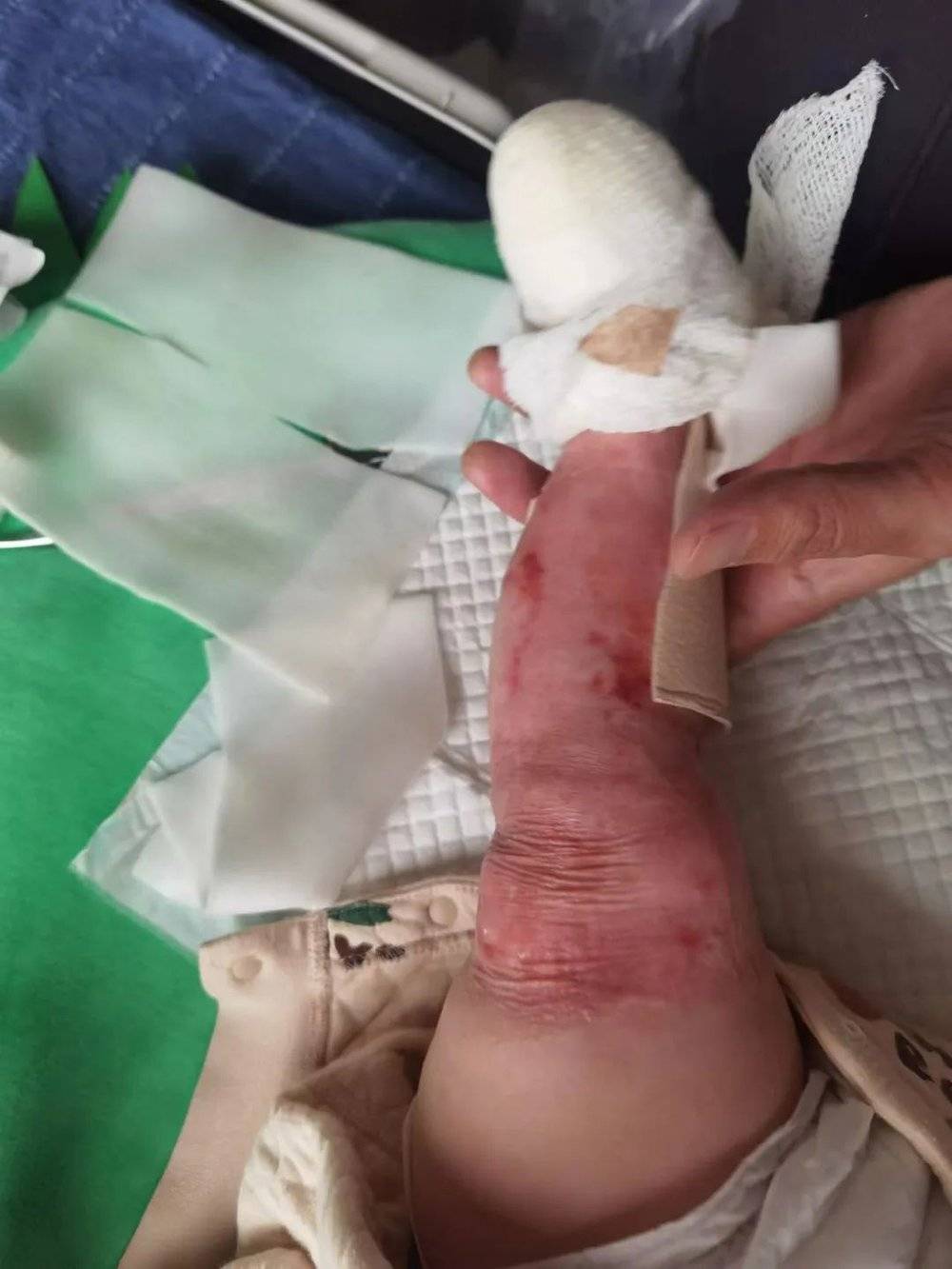 ■ 小九出生后数月，经过护理长出皮肤，但反复受伤的左腿