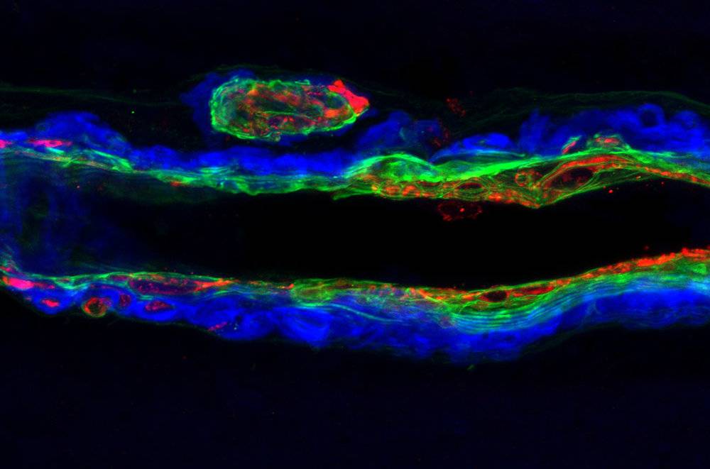 图为血管显微照片显示了淀粉样斑块（蓝色）如何取代血管平滑肌（红色）。研究人员认为，血管膜（绿色）在抗Aβ治疗后发炎、变弱，变得容易出血了。