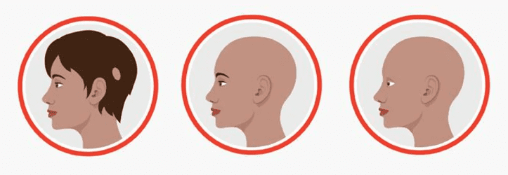 斑秃的三种类型：经典斑秃、全秃、普秃。（https://www.healthywomen.org/created-with-support/alopecia-areata）<br>