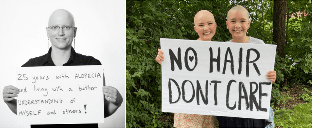 左图，美国斑秃协会网站宣传图片：“斑秃25年，更好地理解自己和他人。”右图，加拿大斑秃协会网站宣传图片：“没有头发，不在话下”。<br>