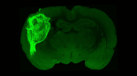 研究人员将一个人脑类器官（亮绿色）移植到新生幼鼠的大脑中，创造了一个神经元连接的融合大脑。来源：斯坦福大学<br>