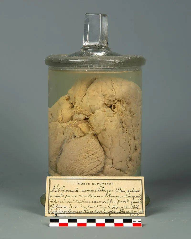 路易·维克多·勒博尔涅的大脑。© Wikimedia Commons