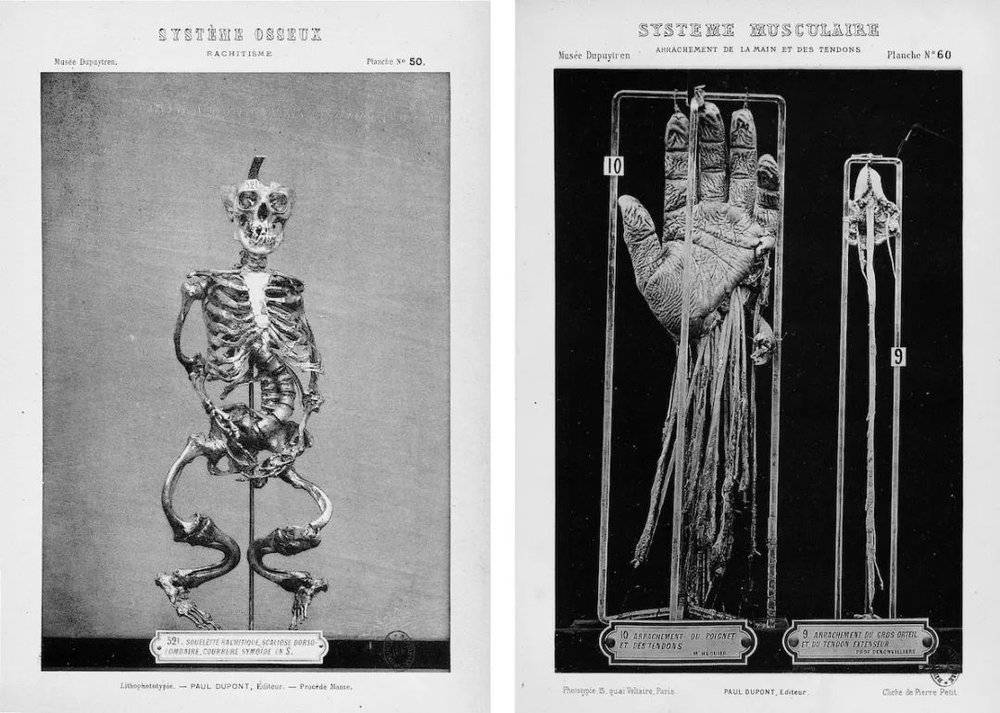 左图：一位佝偻病患者的骨架，死亡时应是一位患有胸腰椎侧凸的年轻女性（藏品521）。右图：一名28岁的机械师的手和肌腱，因衬衫卷进重型机械而随之被卷入扯断（藏品10），一根连着伸肌腱（拇长伸肌）的断裂大脚趾（藏品9）。照片选自夏尔-尼古拉·韦勒的《杜普伊特伦博物馆藏品目录》图集第二、三卷。© gallica.bnf.fr